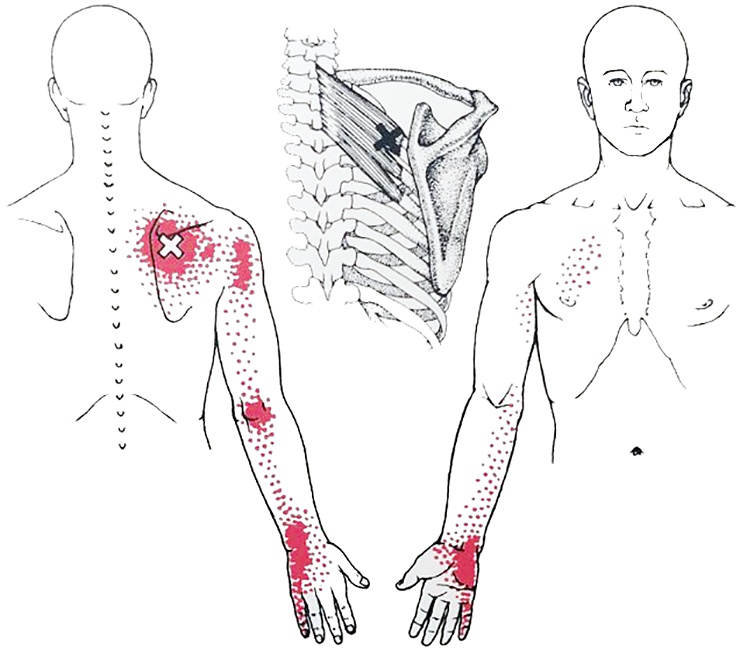 Dry Needling Therapie